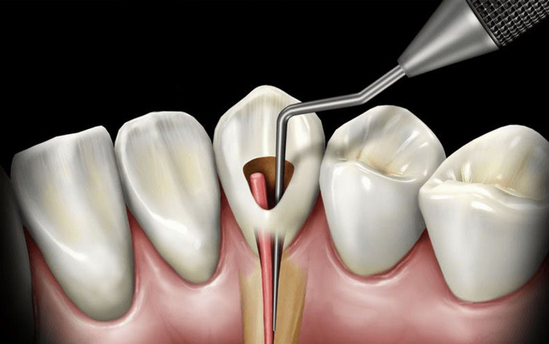 Endodontia-ou-tratamento-de-canal-zona-norte